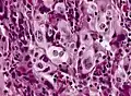 Large cell carcinoma