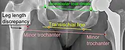 Leg length discrepancy after hip replacement is calculated as the vertical distance between the middle of the minor trochanters, using the acetabular tear drops[104] or the transischial line[20] as references for the horizontal plane. A discrepancy of up to 1&nbsp;cm is generally tolerated.[104][20]