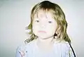 21-month-old, third generation patient, confirmed by genetic tests as Y279C[dead link], exhibiting ocular hyperteliorism, cephalofacial similarity.