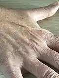Dehydration - low skin turgor