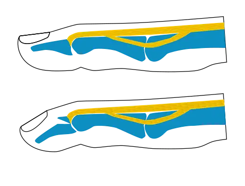 Busch fracture mechanism: because the bit of bone attached to the tendon has broken off, the tendon can't extend the finger tip