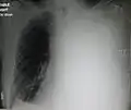 Massive left-sided pleural effusion (whiteness) in a patient presenting with lung cancer