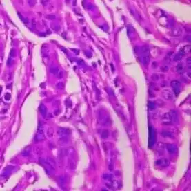 Invasive ductal carcinoma with moderate nuclear pleomorphism