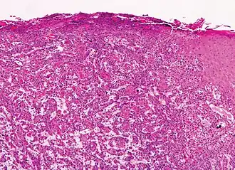 Moderately differentiated lesions of invasive cSCC show much less organization and maturation with significantly less keratin formation.[12]