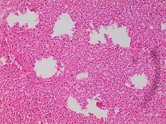 Tearing artifacts, such as can be caused by: - Microtomy with a nick or blemish in the knife edge.[4] - Traction of the sections. - Too much or too little alcohol dehydration.[4] - Sectioning calcified parts, which can be decalcified or removed.[4]