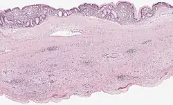 Mucinous cystadenoma of the pancreas