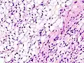 Fig. 3 Lower-power micrograph of myxoid liposarcoma tumor
