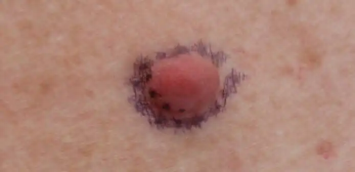 Neurofibroma marked for biopsy, right upper back