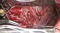 nerves to be sectioned