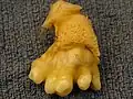 This ovarian teratoma has teeth