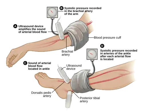 ABI testing is used by vascular surgeons in the diagnosis of PAD. The blood pressure in the arm and leg are compared as a ratio.