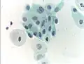 Atrophic squamous cells in postmenopausal women
