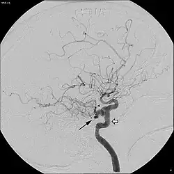 Persistent trigeminal artery