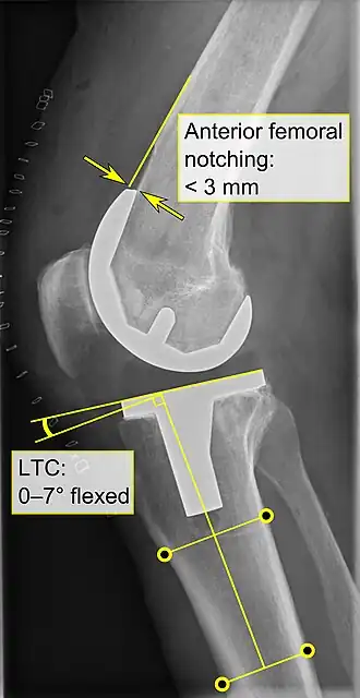 - Anterior femoral notching (the femoral component causing reduced thickness of the distal femur anteriorly), seems to cause an increased risk of fractures when exceeding about 3&nbsp;mm.[67] - LTC: lateral (or sagittal) tibial component angle, which is ideally positioned so that the tibia is 0–7° flexed compared to at a right angle with the tibial plate.[66]