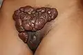 Multi-nodular conglomerate of the pubic area, worsened with surgery.
