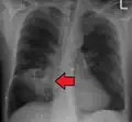 Pulmonary abscess on a chest X-ray