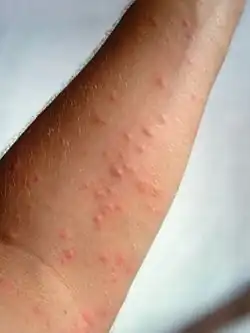 Caterpillar dermatitis (lepidopterism) caused by Oak Processionary (Thaumetopoea processionea)