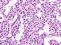 Micrograph of a renal oncocytoma. H&E stain.