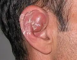 A seroma causing inflammation in part of the outer ear above the external auditory meatus