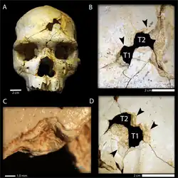 A skull, with close-ups of two fractures