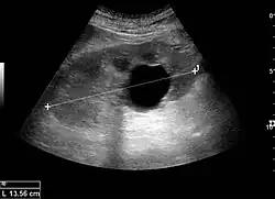 Renal ultrasonography of a simple renal cyst with posterior enhancement
