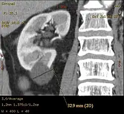 Simple renal cyst.jpg