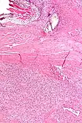 Solitary fibrous tumor - low magnification. H&E stain.