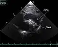 An echocardiogram of a stented persisting ductus arteriosus: One can see the aortic arch and the stent leaving. The pulmonary artery is not seen.
