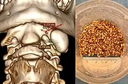 CT scan and fragments of a left submandibular gland stone after sialendoscopic intraductal pneumatic lithotripsy.