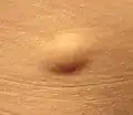 Lipoma[7]