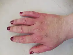 Allergic skin reaction from paclitaxel