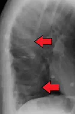 Compression fracture of T12.