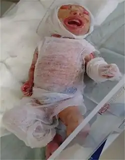 An infant with harlequin ichthyosis, covered in sterile gauze