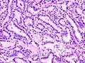 Micrograph showing that the papillae in papillary thyroid carcinoma are composed of cuboidal cells. H&E stain.