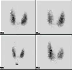 Thyroid scan with iodine-123 for evaluation of hyperthyroidism.