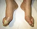 Gout complicated by ruptured tophi, the exudate of which tested positive for uric acid crystals