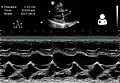 Ultrasound of peripartum cardiomyopathy[23]