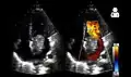 Echocardiogram showing atrial myxoma[9]