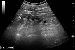 Chronic pyelonephritis with reduced kidney size and focal cortical thinning. Measurement of kidney length on the US image is illustrated by '+' and a dashed line.[20]