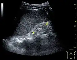 End-stage chronic kidney disease with increased echogenicity, homogenous architecture without visible differentiation between parenchyma and renal sinus, and reduced kidney size. Measurement of kidney length on the US image is illustrated by '+' and a dashed line.[72]