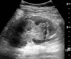 Renal ultrasonograph in renal trauma with laceration of the lower pole and subcapsular fluid collection below the kidney[20]