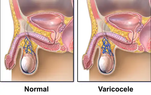 Diagram of a varicocele