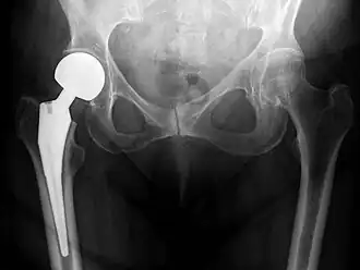 X-ray of the hips, with a right-sided hemiarthroplasty