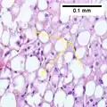 MASH (inflammation) and fibrosis stage 2